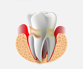 Лечение периодонтита